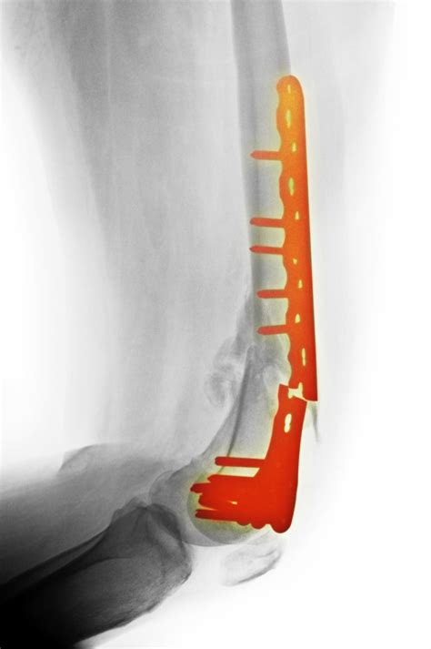 metal implants for broken bones